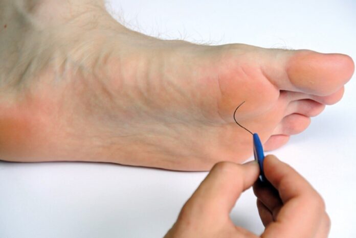 Signs You Have Diabetic Foot Problems
